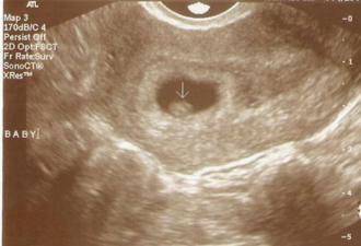 Третья неделя от зачатия Эмбрион 3 недели после зачатия